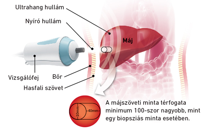 iLiV Touch  FT100 hepatológiai diagnosztikai berendezés